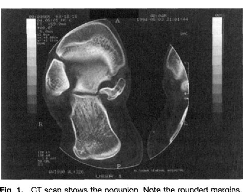 Figure 1 From Nonunion Of A Fracture Of The Sustentaculum Tali Causing