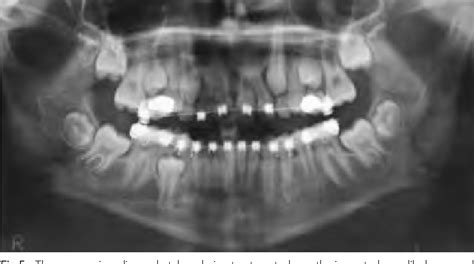 Figure 6 From Uprighting Of Mandibular Second Molars With The Sectional