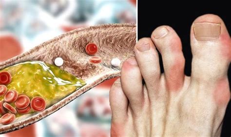 High Cholesterol Symptoms Bumps That Are Different Shapes On Feet Are
