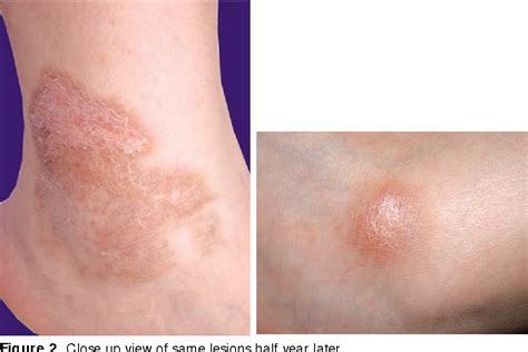 Figure 2 From Interstitial Granulomatous Dermatitis Presenting As