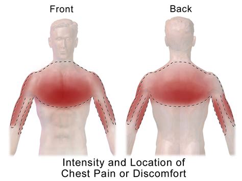 Find out your body type and build a workout program for your specific body type: Chest pain - Wikiwand