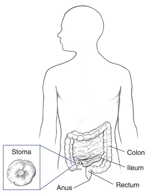 Stoma Of The Ileum With Labels For The Colon Ileum Rectum And Anus
