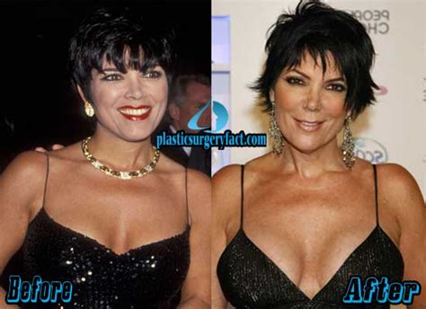Kris Jenner Plastic Surgery Before And After Photos