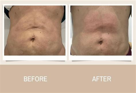 How Is The Non Invasive Treatment Fibrosis After Lipo Bandv After Lipo Care