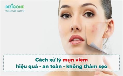 Cách Xử Lý Mụn Viêm Hiệu Quả An Toàn Và Không Thâm Sẹo Dizigone