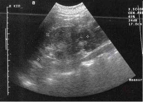 Figure 1cystic Nephroma A Case Report And Review Of The Literature