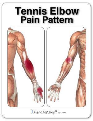 In many cases, the pain will go away in about a week. 81 best images about Tennis Elbow and Golfers Elbow on ...