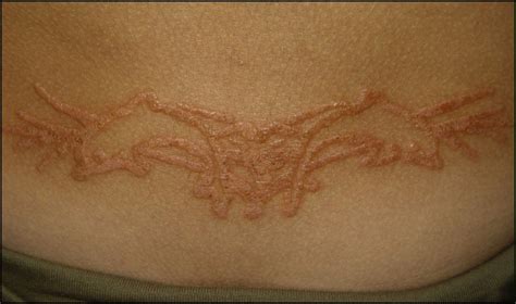 Eczema Over A Henna Tattoo The Limits Of The Eczema Are Marked By The