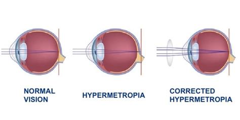 Hypermetropia Causes And Treatments Dr Alberto Bellone