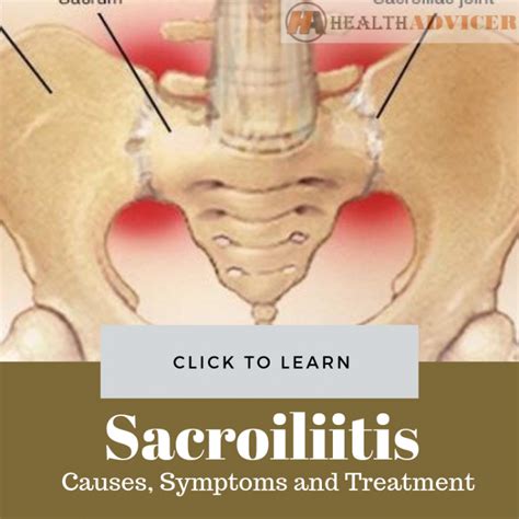 Sacroiliitis Causes Picture Symptoms And Treatment