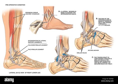 Lateral Ankle Ligament Instability With Surgical Reconstruction Stock