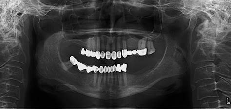 Mucosal somatic sensation of the nasal cavity is derived from numerous nerves, but in general terms the branches of the ophthalmic division of the trigeminal nerve (cn va) supply the anterosuperior half whereas branches of the maxillary division. Floor Of Nasal Cavity Radiograph | Viewfloor.co