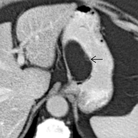 Intramural Benign Gastric Tumors Radiology Key