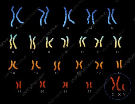 Klinefelters Syndrome Karyotype Illustration Stock Image C0555521 Science Photo Library