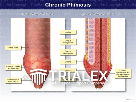 Chronic Phimosis Trial Exhibits Inc