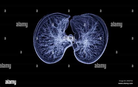 Ct Chest Or Ct Lung 3d Rendering Image With Blue Color Showing Trachea