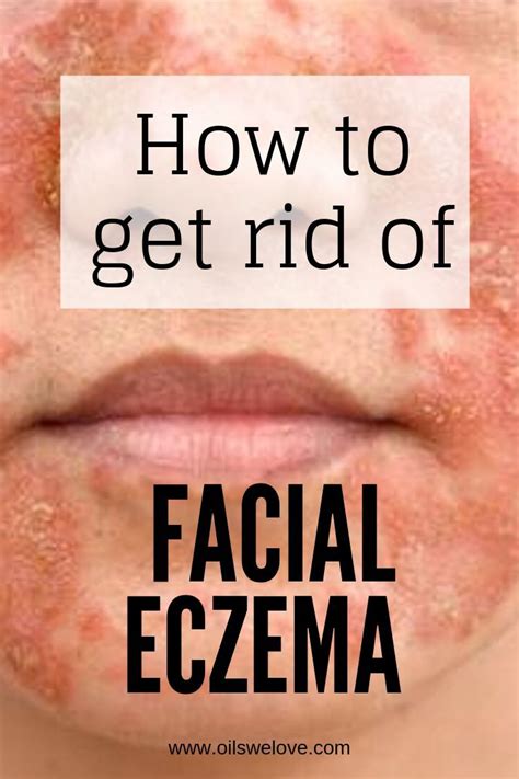 40 Natural Eczema Treatments And Remedies Facial Eczema Home Remedies