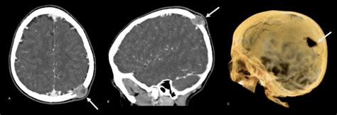 Head Ct Solid Osteolytic Lesion In The Left Parietal Region With