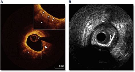 Ivus Oct And Coronary Artery Calcification Is There A Bone Of