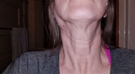 Enlarged Lymph Nodes In The Neck Symptoms Causes Diagnose