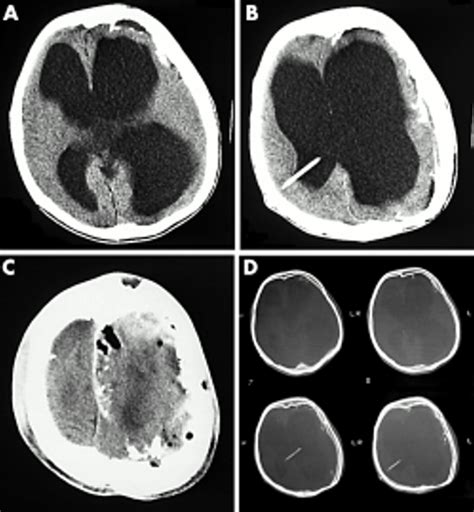 Giant Calcified Chronic Subdural Haematoma A Long Term Complication Of
