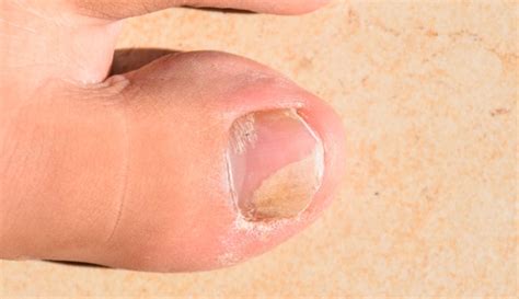 What Does Toenail Fungus Look Like When It First Starts Nailsr