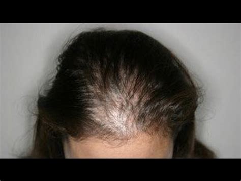 According to the american hair loss association , women make up to 40 percent of those who experience hair loss in the u.s. ADIOS A LA CALVICIE & CAÍDA DEL CABELLO CON ESTE SHAMPOO ...