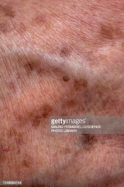 Old Age Spots On Skin Imagens E Fotografias De Stock Getty Images