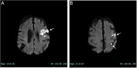 Ischemic Stroke A Rare Complication Of A Large Multinodular Goiter In