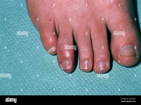 Chilblain A Patients Toe Swollen To A Rounded Shape Red And Itchy