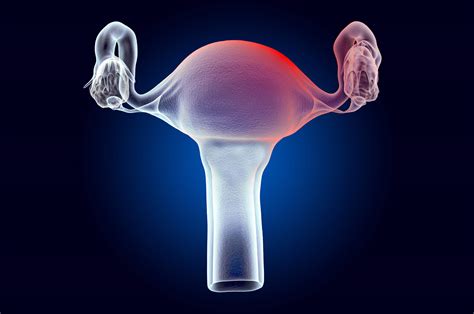 Miomas uterinos síntomas causas y tratamiento Muy Salud