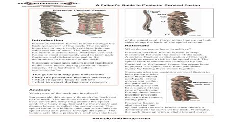 A Patients Guide To Posterior Cervical Fusiona Patients Guide To Posterior Cervical Fusion