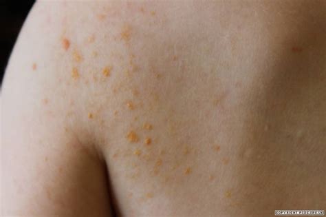 Xanthoma Types Symptoms Causes And Risk Factors