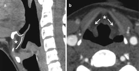 Larynx And Hypopharynx Radiology Key