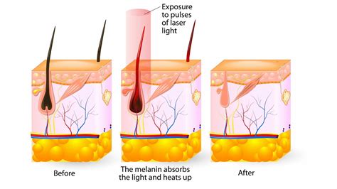 How Does Laser Hair Removal Work London Premier Laser And Skin Clinic