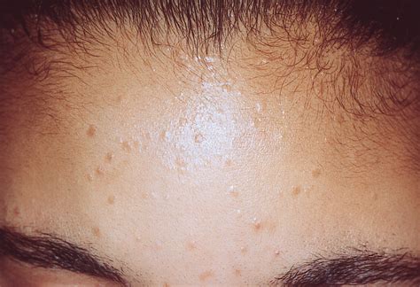 Successful Treatment Of Flat Warts Using Intralesional Candida Antigen