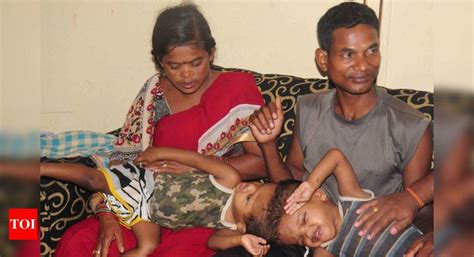 Odisha Conjoined Twins Notice Over Shifting Of Odisha Conjoined Twins Delhi News Times Of India