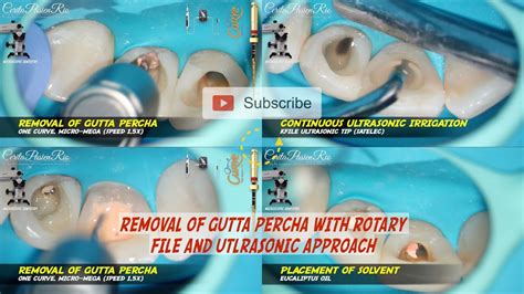 Removal Gutta Percha With One Curve Micromega Continuous Ultrasonic