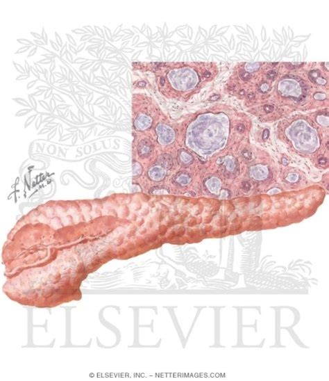 Cystic fibrosis is an inherited disease characterized by the buildup of thick, sticky mucus that can in people with cystic fibrosis, mucus often damages the pancreas, impairing its ability to produce. Pancreatic Disease In Cystic Fibrosis