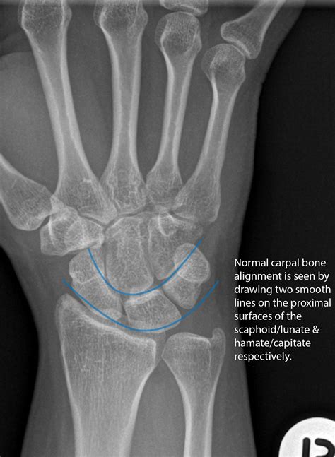 Carpal Bone X Ray Normal