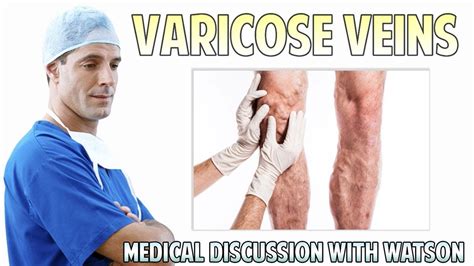 Varicose Veins Everything You Need To Know Youtube