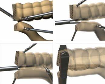 Операция при раке сигмовидной кишки - удаление, лапароскопия. - ЦРБ Картинка - Операция при раке сигмовидной кишки - удаление, лапароскопия. - ЦРБ