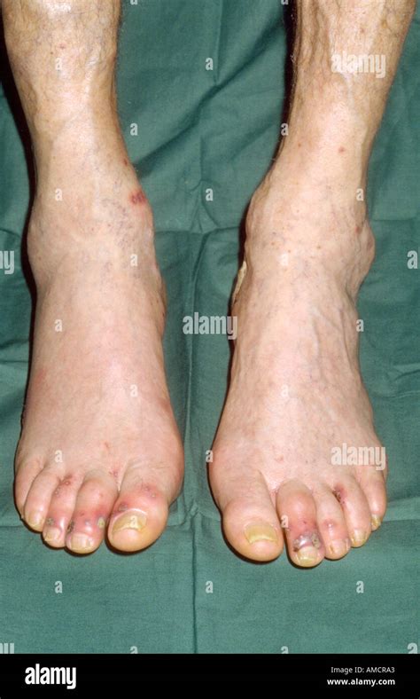Vasculitis On Feet Hi Res Stock Photography And Images Alamy