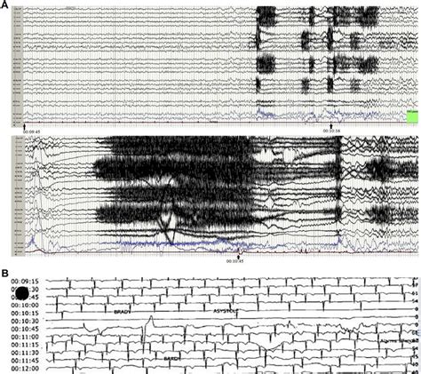 Captured Simultaneous Eeg And Ecg Recording Of 38 Second Ictal Download Scientific Diagram