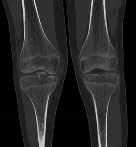 Tibial Eminence Avulsion Fracture Meyers And Mckeever Type 3b Image