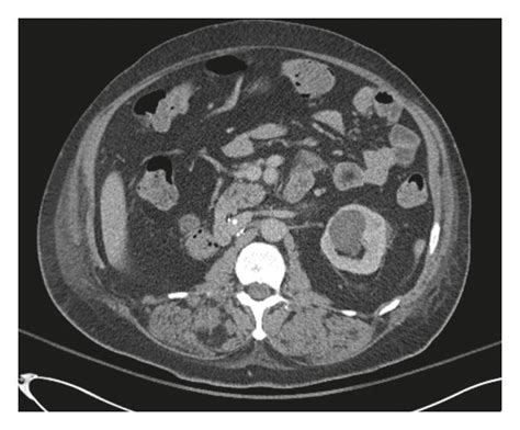 Contrast Enhanced Ct Scan Of The Abdomen A Two Years Before