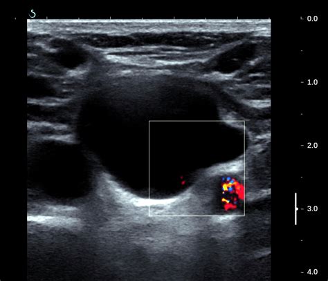 Vietnamese Medic Ultrasound Case Parathyroid Cyst Dr Phan Thanh