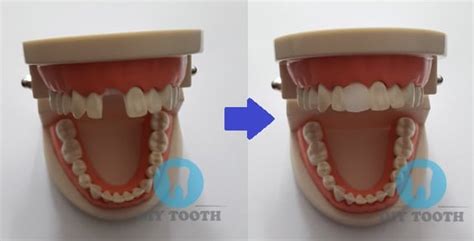 Check spelling or type a new query. DIY tooth - Realistic temporary tooth replacement solution