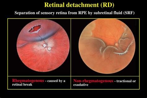Ppt Introduction To Retinal Detachment Rd Powerpoint Presentation