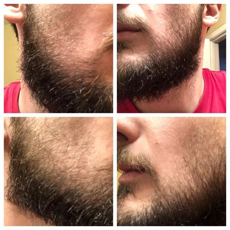 Patchy Beard Success Stories Before And After Photos Page 35 Beard